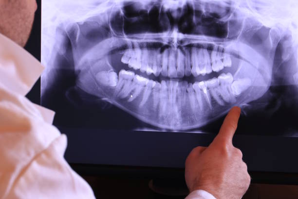 Best Emergency Wisdom Tooth Extraction in Squirrel Mountain Valley, CA
