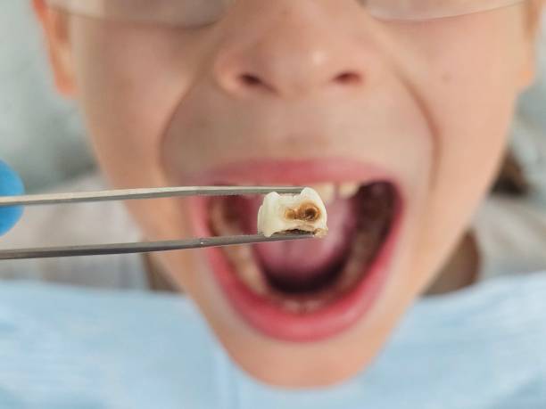 Best Emergency Root Canal Therapy in Squirrel Mountain Valley, CA